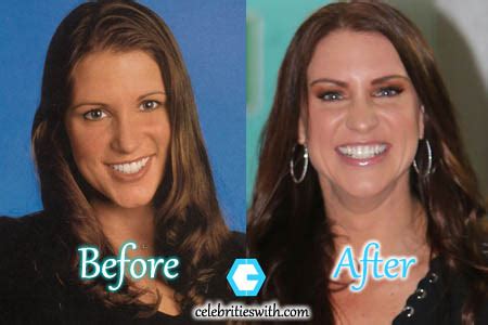 Stephanie McMahon Plastic Surgery: Before and After Her Boob Job